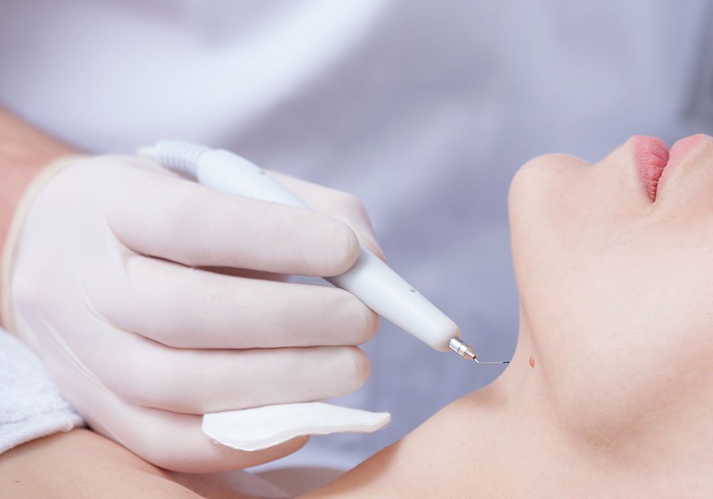 Cauterização de Verrugas