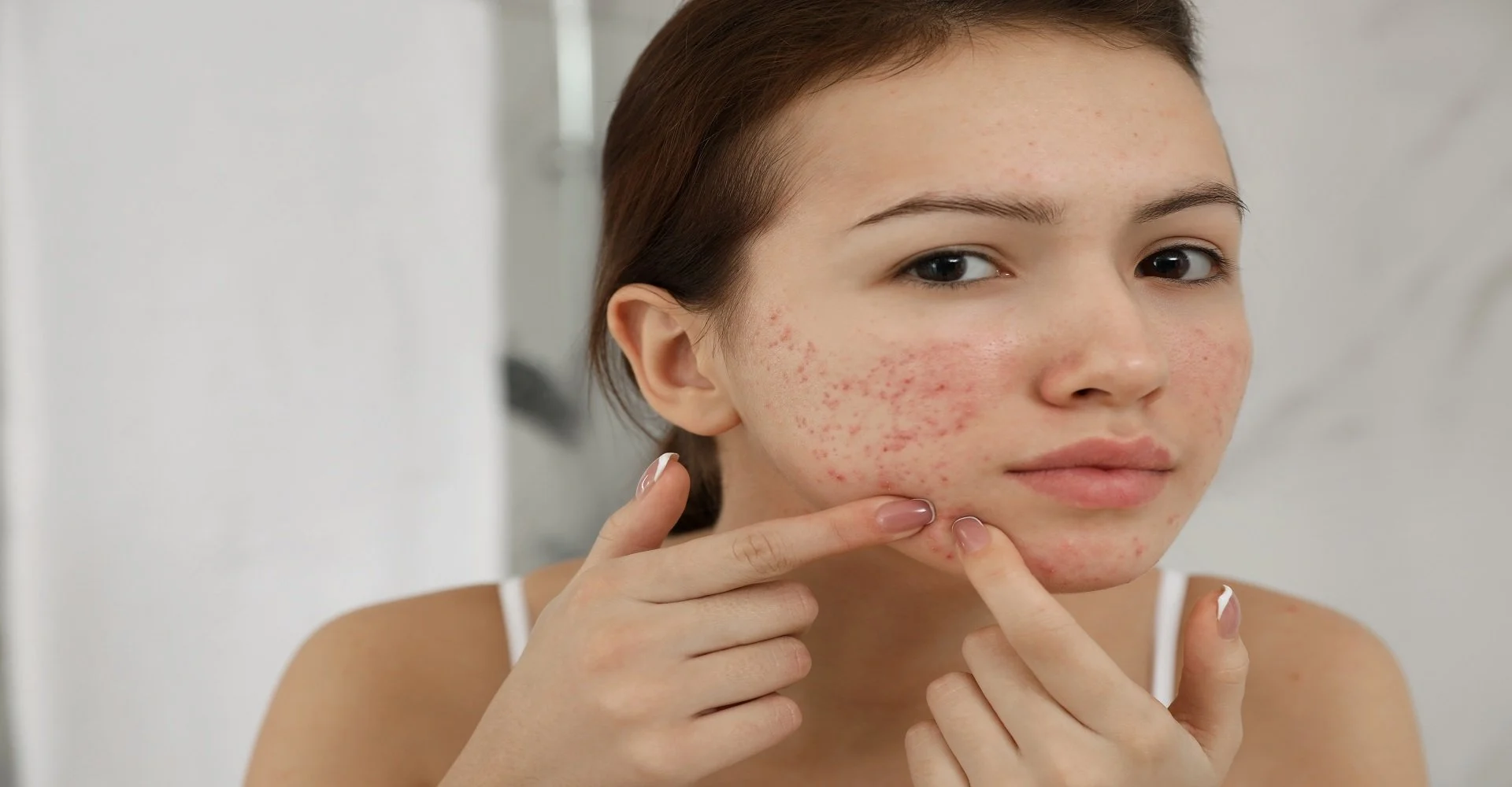 Espinhas na adolescência – o que causa a acne?