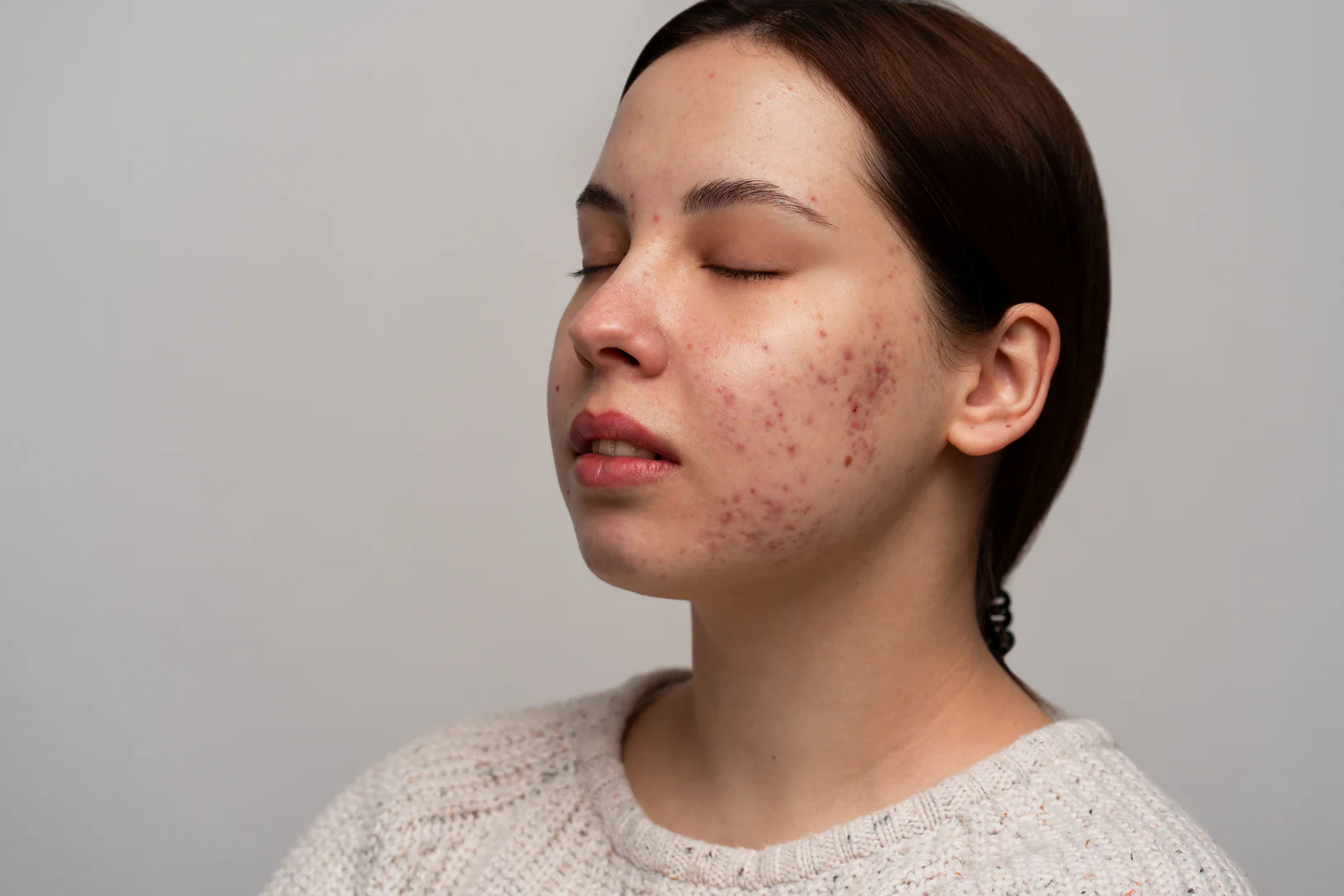Acne na Fase Adulta
