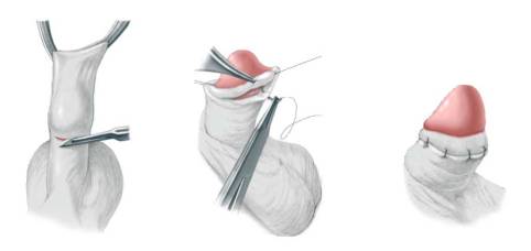 Postectomia e Saúde Sexual