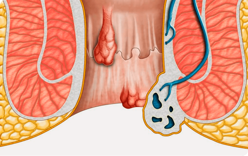 Mitos e Verdades sobre a Hemorroidectomia