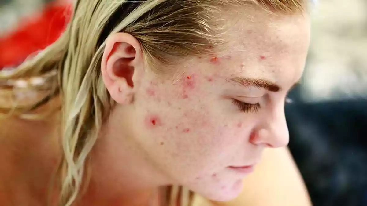 Acne na idade adulta: Por que ela aparece e como tratá-la?