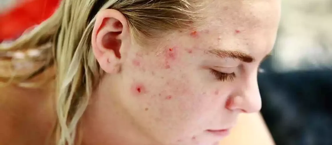 Acne na idade adulta: Por que ela aparece e como tratá-la?